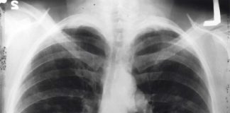 Cancro do pulmão: cientistas de Coimbra desenvolvem compostos inovadores para tratamento cancro do pulmao